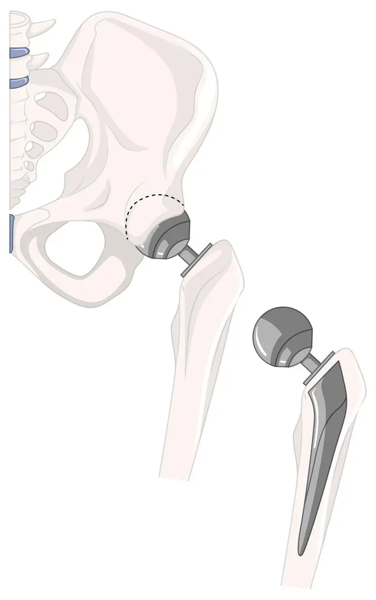 hip replacement surgery Massapequa NY